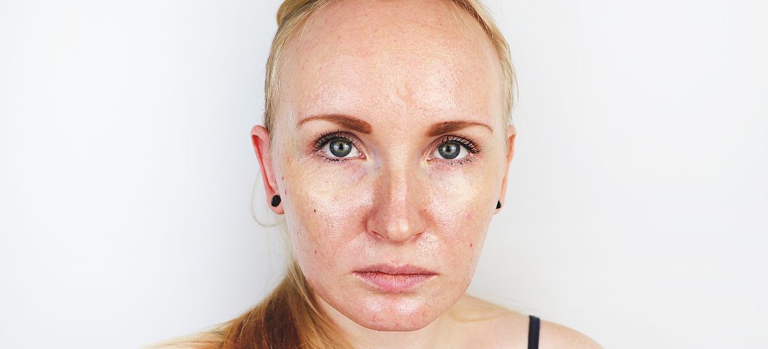 Woman's face close-up, prominent pores, red texture, oily skin