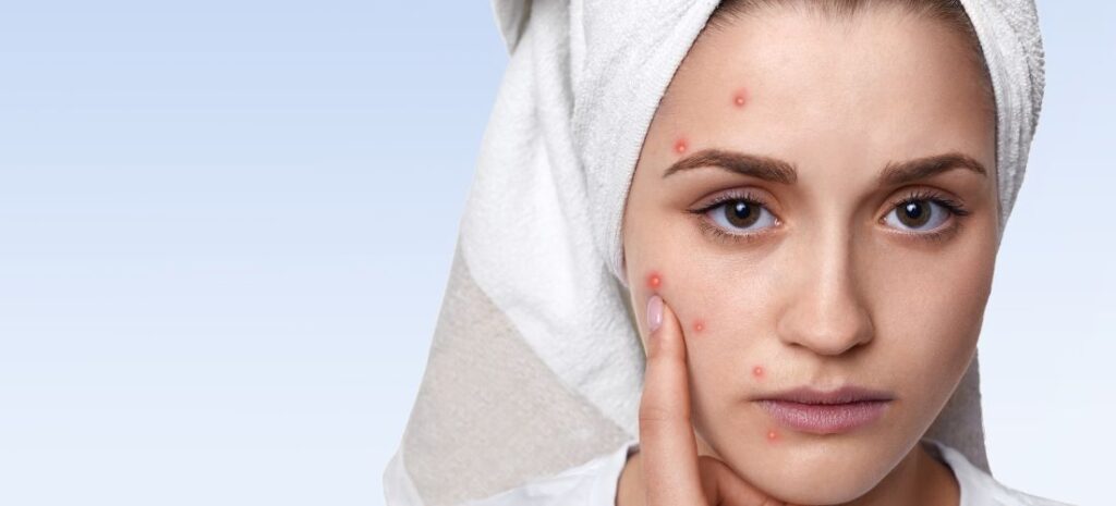 Woman pointing at a pimple on her cheek, acne, towel wrapped hair, remove pimple